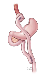 Gastric Bypass Image for obesity
