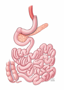 Sleeve Gastrectomy Image